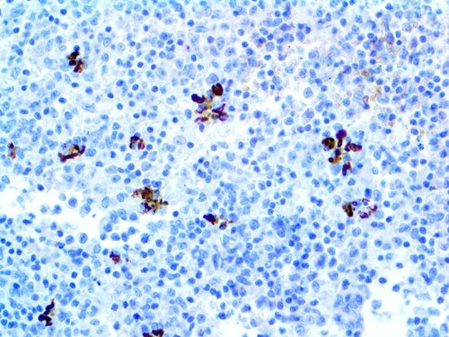 IHC of Perforin on an FFPE Lymphoma Tissue